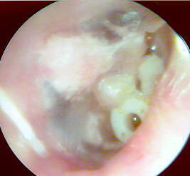 MURAL CHOLESTEATOMA IN 13 YEAR FEMALE PATIENT